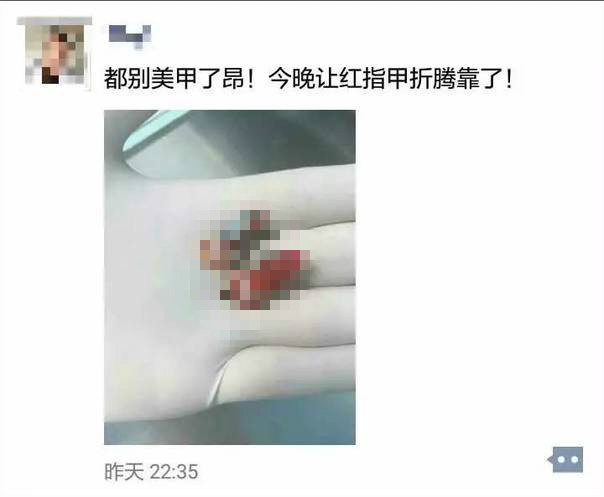 19岁幼师两节手指被瞬间拽断！罪魁祸首竟是美甲